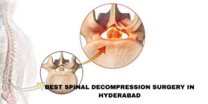 Best spinal decompression surgery in Hyderabad